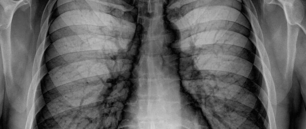 Chest_Xray_PA_3-8-2010_inverted