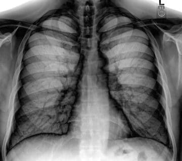 Chest_Xray_PA_3-8-2010_inverted