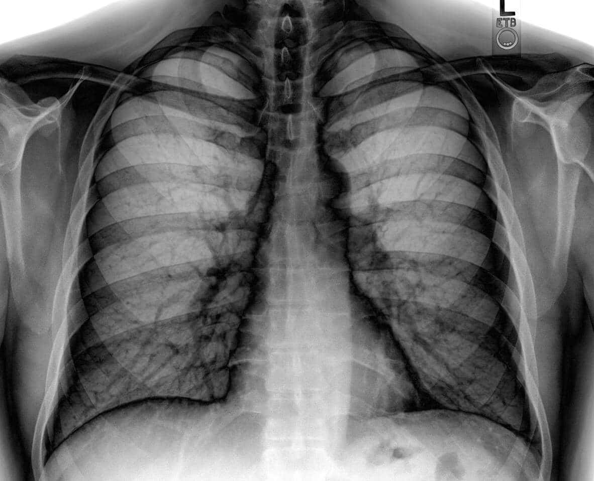 Chest_Xray_PA_3-8-2010_inverted