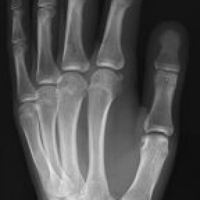 286px X ray of normal hand by oblique projection 144x300