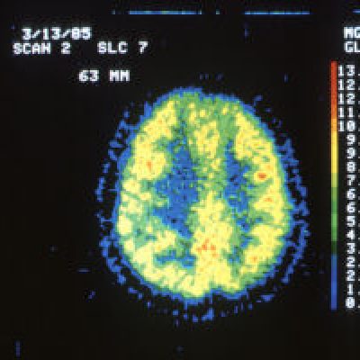 800px Pet scan of a normal brain 300x200