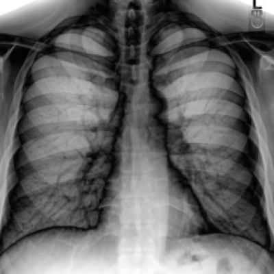 Chest_Xray_PA_3-8-2010_inverted-300x243.png