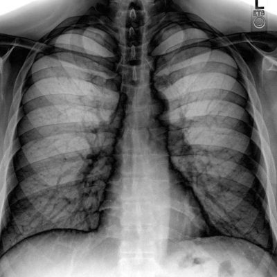 Chest Xray PA 3 8 2010 inverted