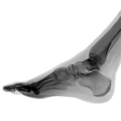Foot x rays 300x300