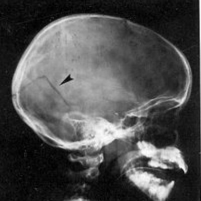 Skull Fracture X ray